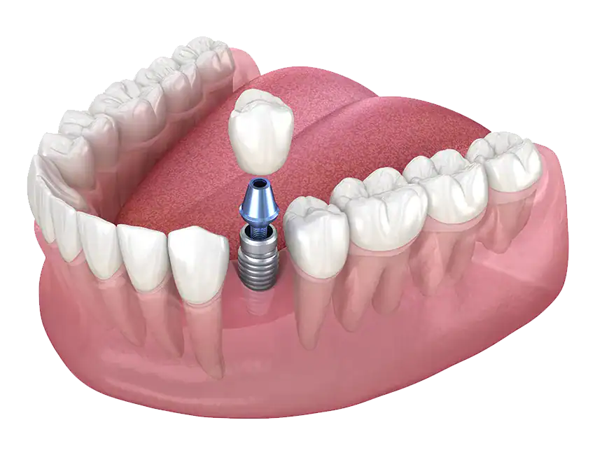 save your tooth