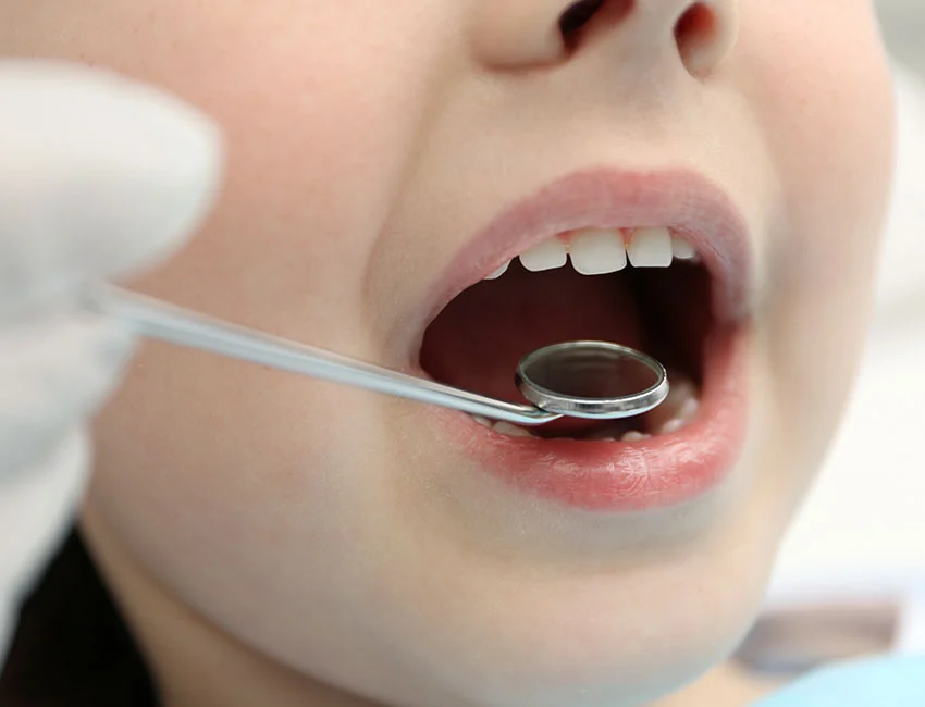 Young patient with dental sealants