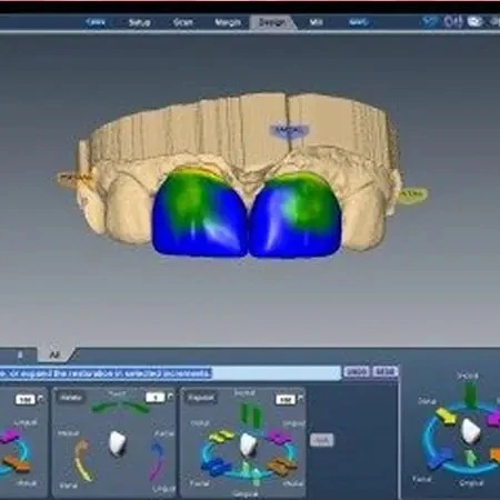 DIAGNOdent Laser Cavity Detection