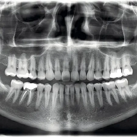 Low Dose Digital X-Rays