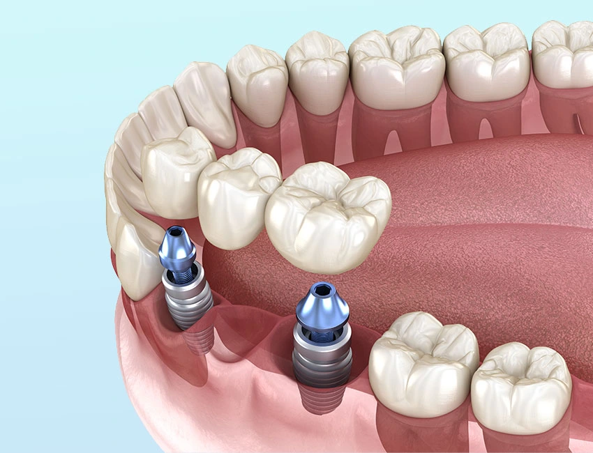 Multiple-Tooth implants in Woodland Hills, CA