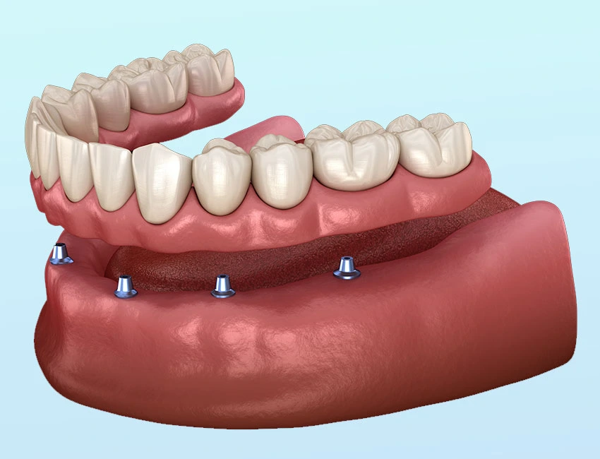 Implant Supported Dentures in Woodland Hills, CA